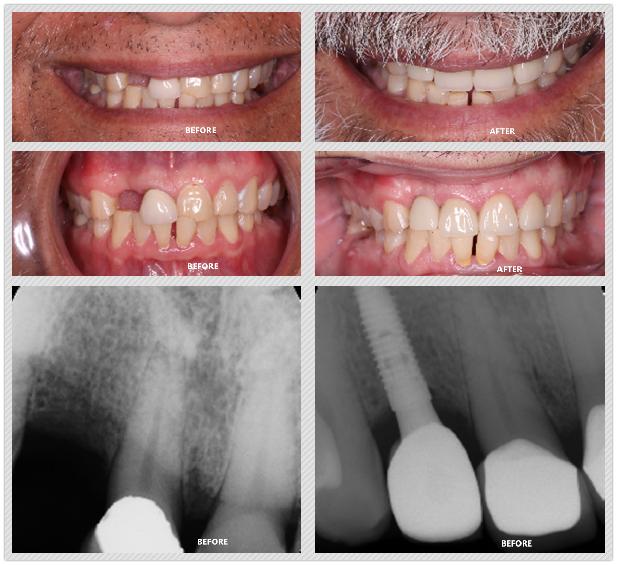 Dental Implant Case 02