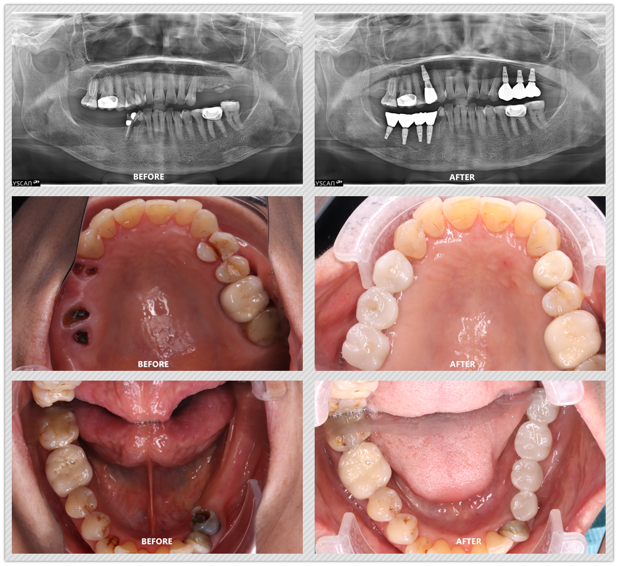 Dental Implants Case 01