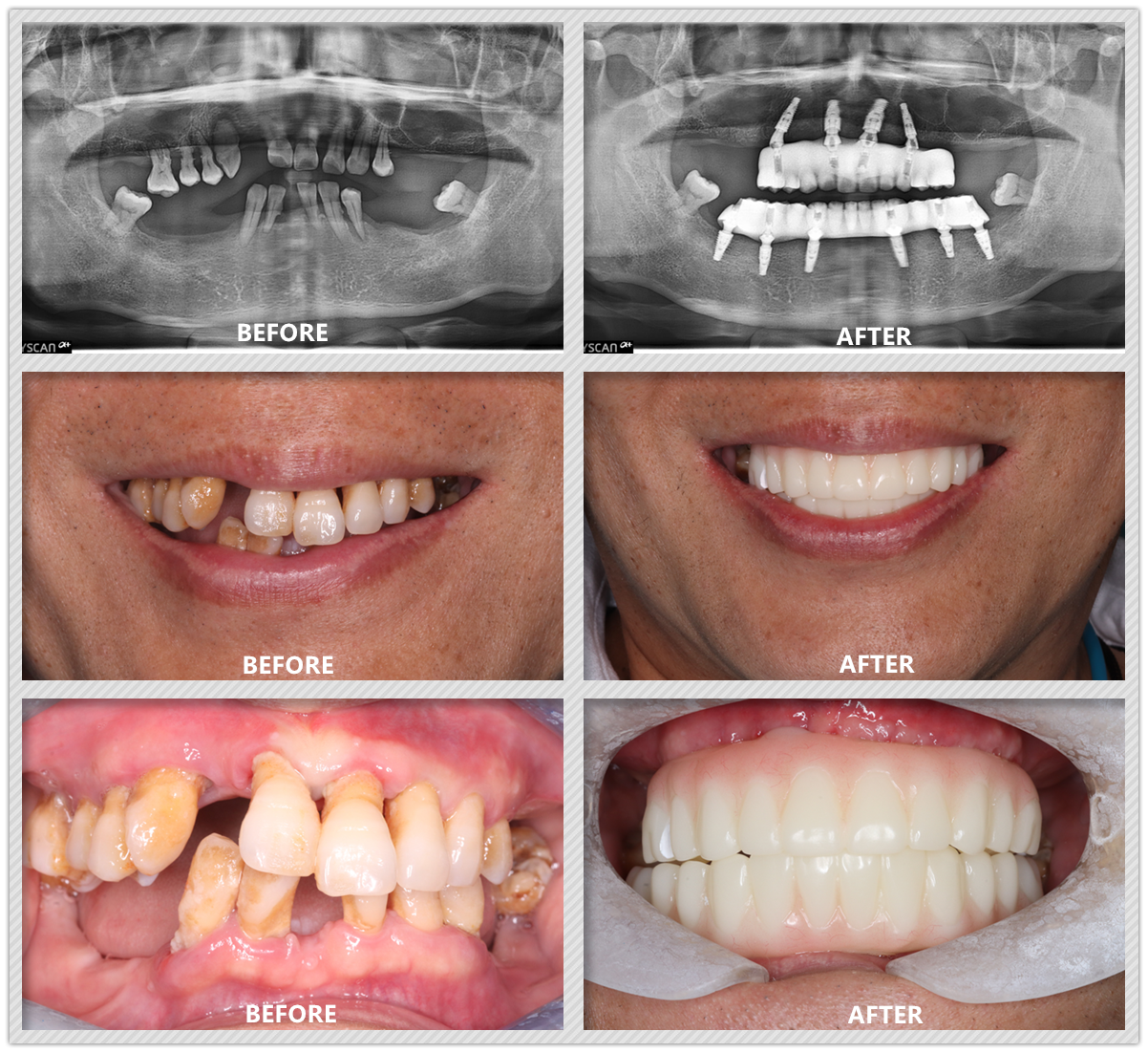 Full Mouth Dental Implants