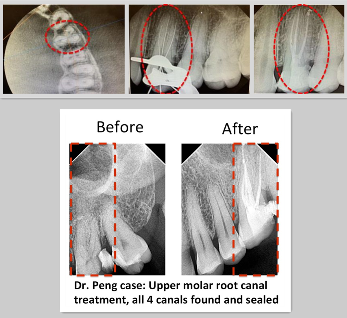 Root Canal Case 01