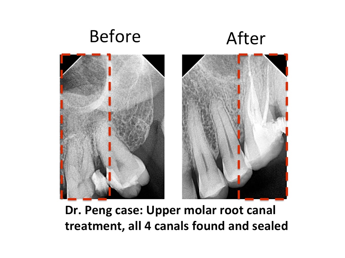 Root Canal Case 02