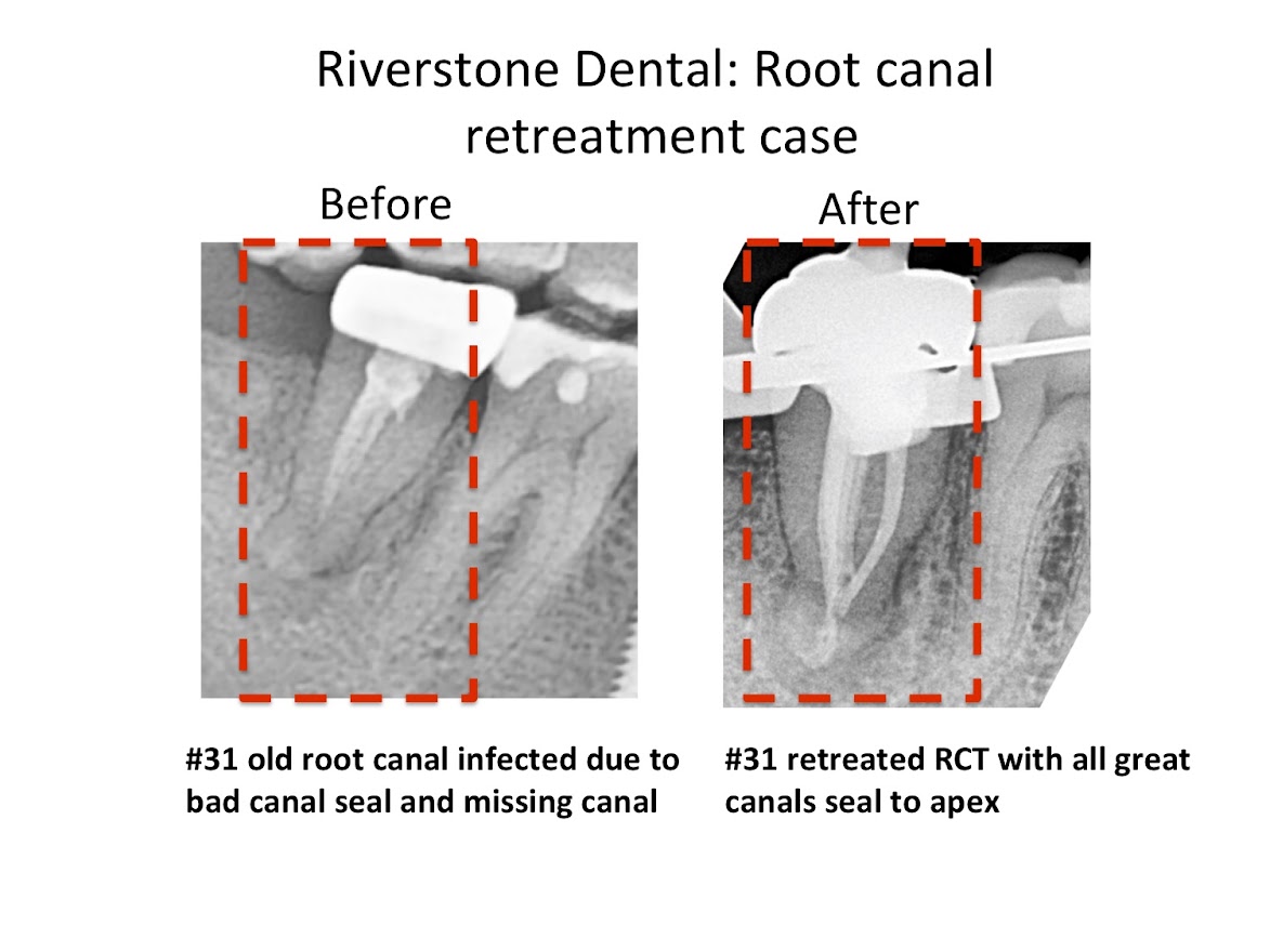 Root Canal Case 03